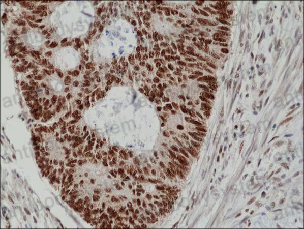 Immunohistochemical for Anti-Human MSH2 Polyclonal Antibody ?>