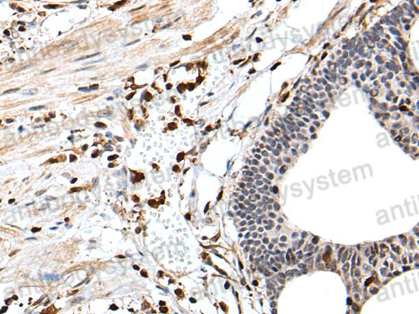 Immunohistochemical for Anti-ARHGDIB Polyclonal Antibody ?>
