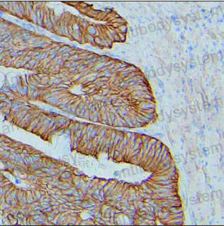 Immunohistochemical for Anti-CTNND1 Antibody (R2V39) ?>