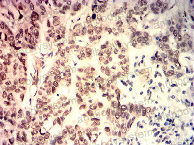 Immunohistochemical for Anti-MYC Antibody (R2X12) ?>