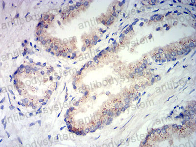 Immunohistochemical for Anti-PSAP Antibody (R3A31) ?>