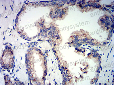 Immunohistochemical for Anti-PSAP Antibody (R3A31) ?>