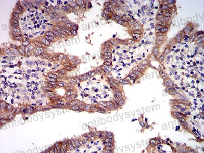Immunohistochemical for Anti-MET/c-Met/HGFR Antibody (R3B08) ?>