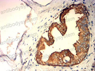 Immunohistochemical for Anti-KLK2 Antibody (R3F52) ?>