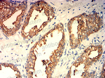 Immunohistochemical for Anti-KLK2 Antibody (R3F52) ?>