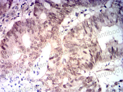 Immunohistochemical for Anti-MLH1 Antibody (R3K39) ?>