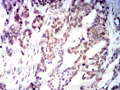 Immunohistochemical for Anti-MLH1 Antibody (R3K39) ?>