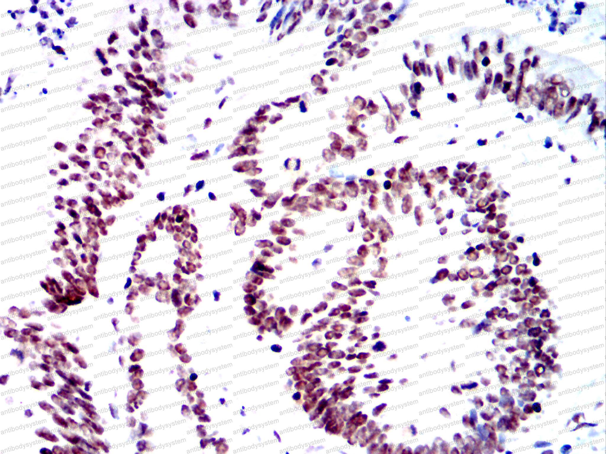 Immunohistochemical for Anti-SMARCA2 Antibody (R3M52) ?>