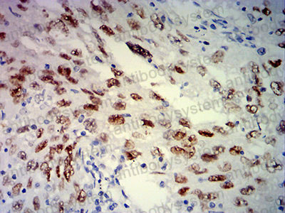 Immunohistochemical for Anti-MSH6 Antibody (R3M87) ?>
