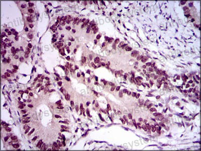 Immunohistochemical for Anti-E2F1/RBBP3 Antibody (R3Q30) ?>